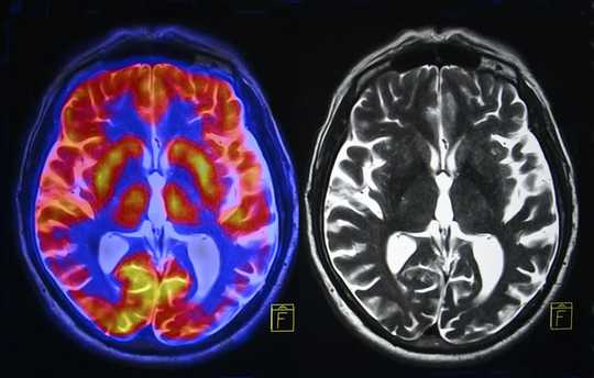 How Chronic Stress Changes The Brain And What You Can Do To Reverse The Damage