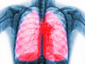 An illustration of immune cells interacting with lung tissue, representing the role of immune cells in long COVID lung scarring and potential treatment strategies.