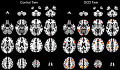 Seeing The Actual Problem In The Brain Decreases The Stigma Of Illness