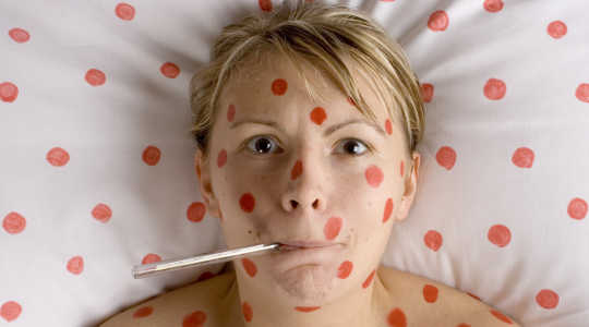 Everything You Need To Know About Chickenpox