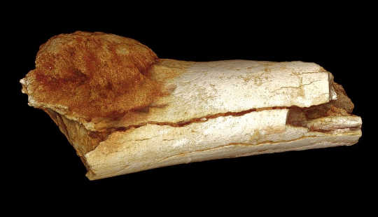 Volume rendered image of the external morphology of the foot bone shows the extent of expansion of the primary bone cancer beyond the surface of the bone. Patrick Randolph-Quinney (UCLAN)