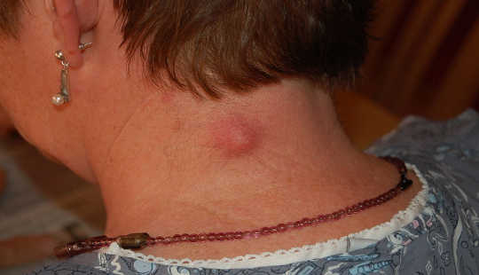 An inflamed epidermal inclusion cyst. Steven Fruitsmaak/Wikimedia Commons