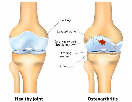 Science Or Snake Oil: Is Glucosamine Good For Joints?