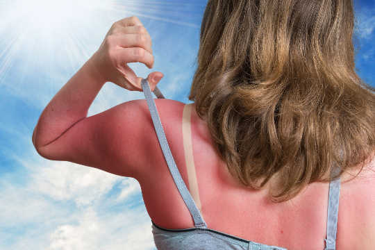 What Happens To Your Skin When You Get Sunburnt?