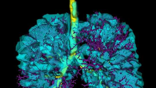 Vaping: As An Imaging Scientist I Fear The Deadly Impact On People’s Lungs