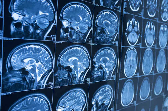 Human brain structure is the same in males and females.