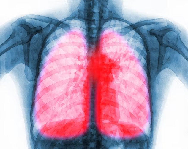 An illustration of immune cells interacting with lung tissue, representing the role of immune cells in long COVID lung scarring and potential treatment strategies.