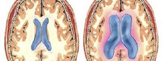 What Is Hydrocephalus