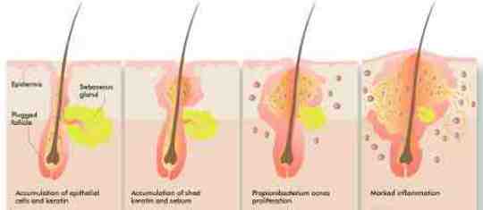 What are the Causes of Acne?