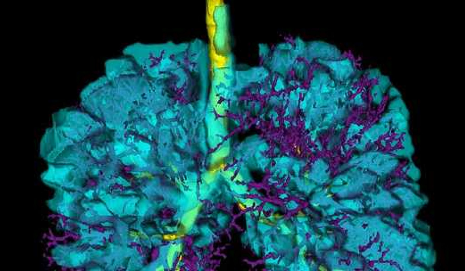 Vaping: As An Imaging Scientist I Fear The Deadly Impact On People’s Lungs