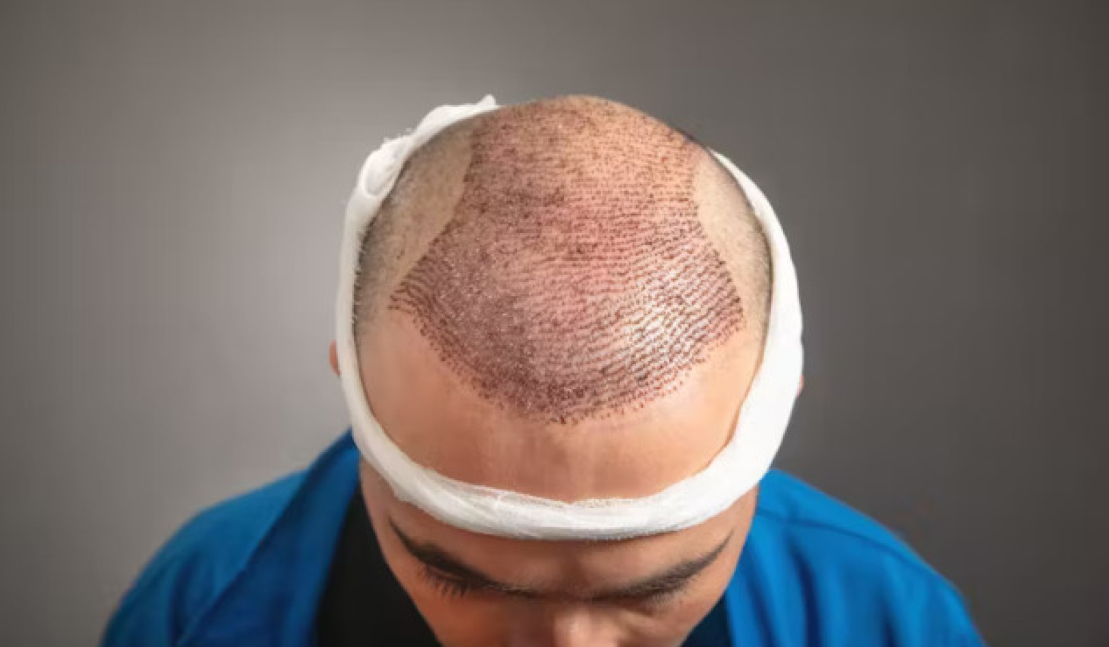 Hair Transplant Risks: What You Need to Know Before Surgery