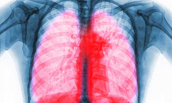 An illustration of immune cells interacting with lung tissue, representing the role of immune cells in long COVID lung scarring and potential treatment strategies.