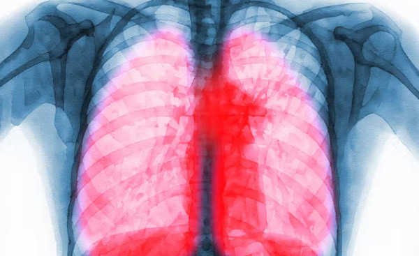 An illustration of immune cells interacting with lung tissue, representing the role of immune cells in long COVID lung scarring and potential treatment strategies.