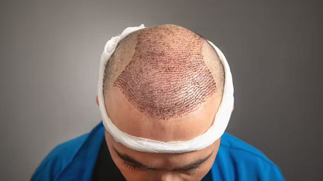 A doctor performing hair transplant surgery, showing precision in handling grafts to ensure minimal risk and optimal recovery.