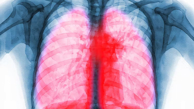 An illustration of immune cells interacting with lung tissue, representing the role of immune cells in long COVID lung scarring and potential treatment strategies.